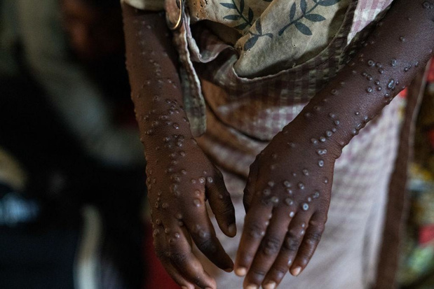 Mpox : l'Unicef a lancé un appel d'offres pour obtenir des vaccins